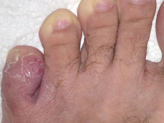 Eating of the skin on the left pinky toe caused by a Fungal Infection.