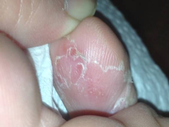 Eating of the skin on the left pinky toe caused by a Fungal Infection.