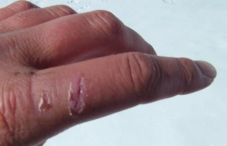 Latest on the finger