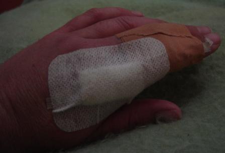 Poorly finger
