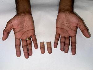 Silicone finger prosthesis