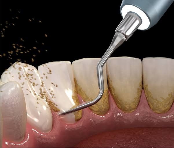 Periodontal & Gum Care