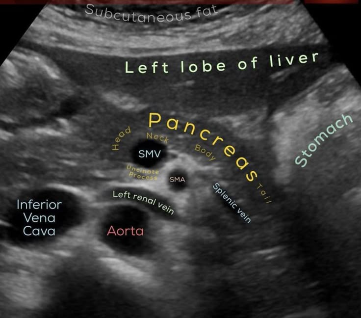 USG Lower Abdomen