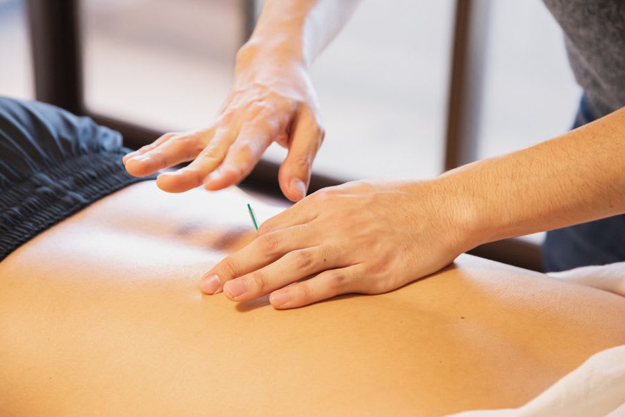 séance d'acupuncture pour maigrir