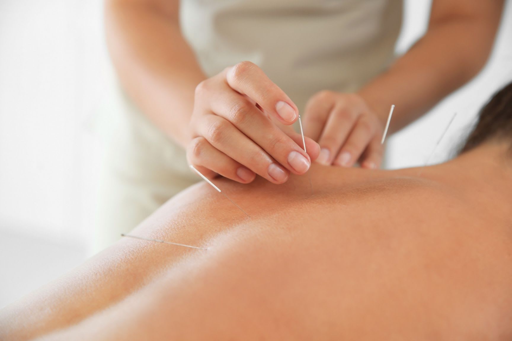 séance d'acupuncture pour soulager les douleurs menstruelles