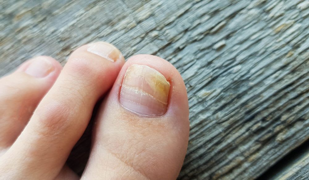 mycose-ongle.jpg