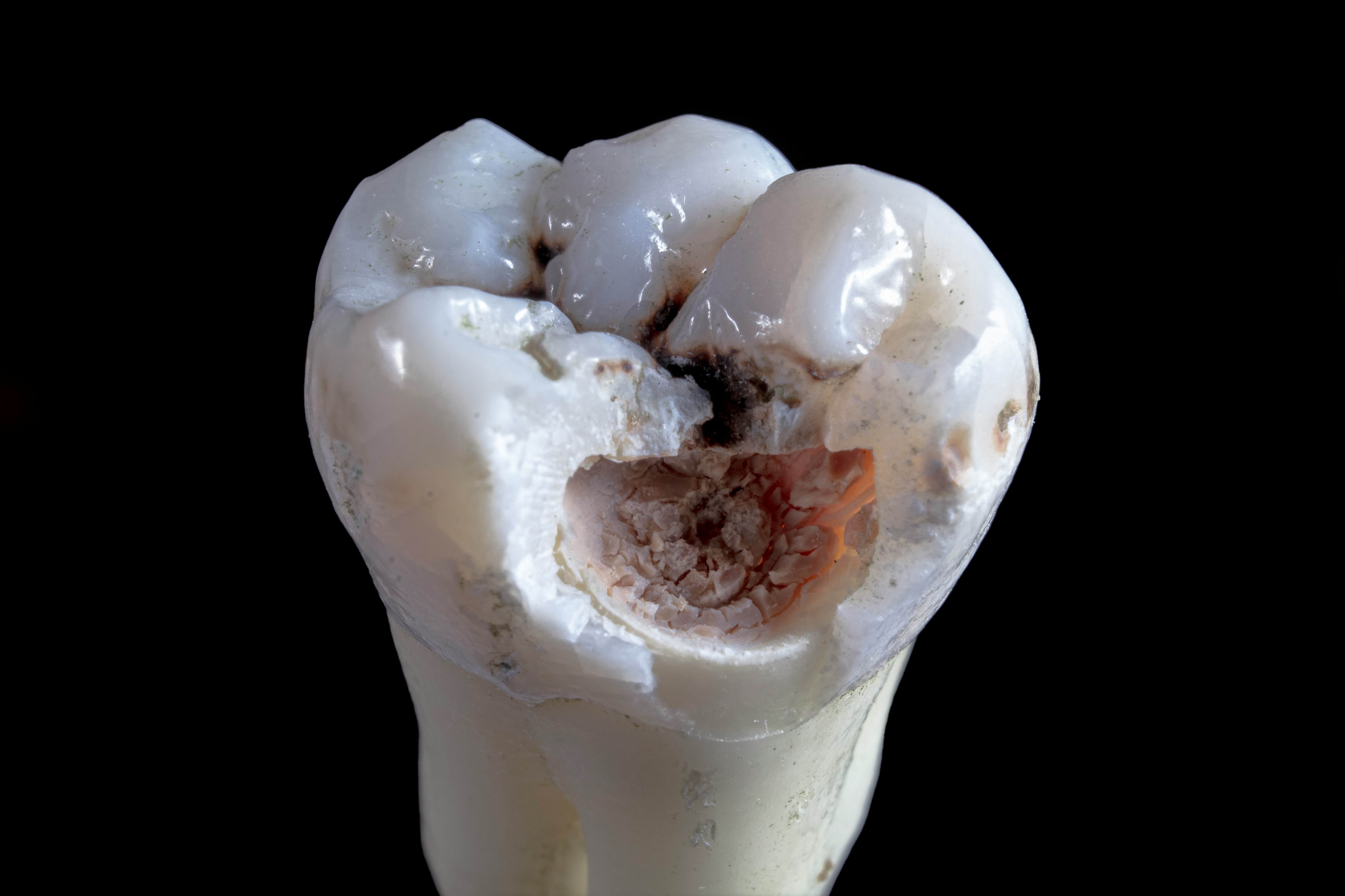 Tooth Decay