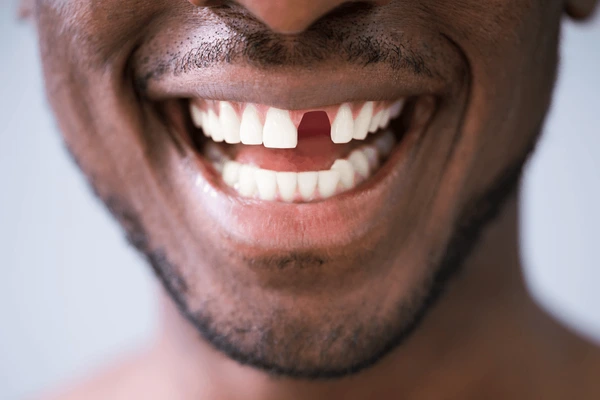Replacing Missing Teeth: Your Best Options Explained