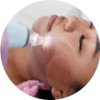 40% Off Your First RF Microneedling Face Treatment!