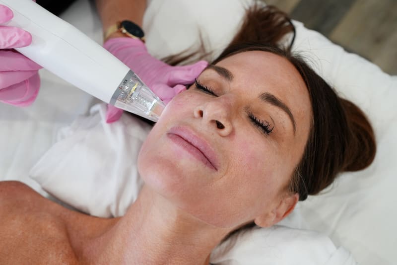 40% Off Your First RF Microneedling Face Treatment#*