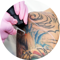 Full Tattoo Removal treatment area