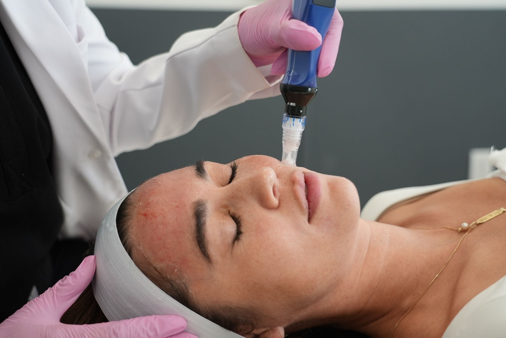 SkinPen® Microneedling treatment area