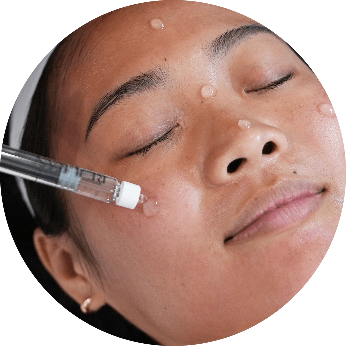 Rejuran® Scar Therapy treatment area