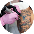Laser Tattoo Removal
