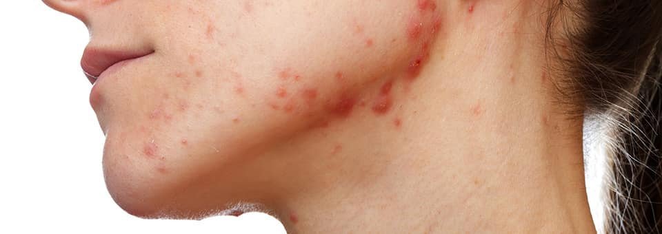 laser treatments for acne scars