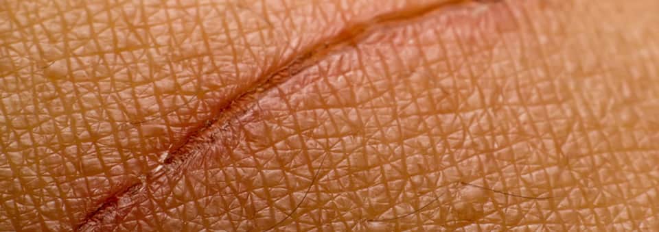 how to remove scars