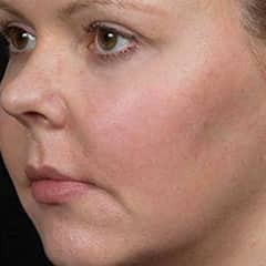 Before &amp; After | LaserAway