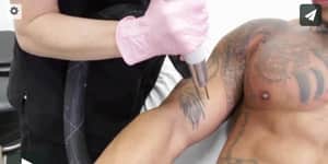 Laser tattoo removal near me