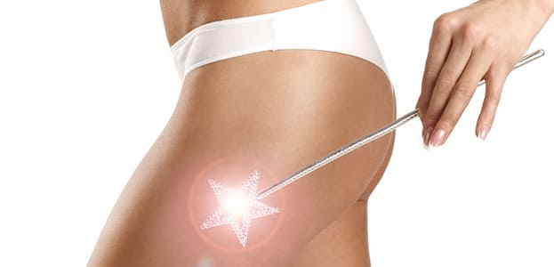Thermage treatment results