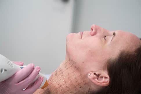Lady getting Thermage procedure on neck area