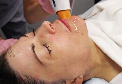 Woman getting Thermage NXT treatment in Scottsdale, AZ at LaserAway