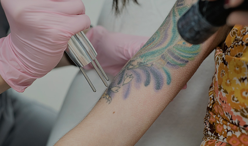 Laser Tattoo Removal Services LaserAway