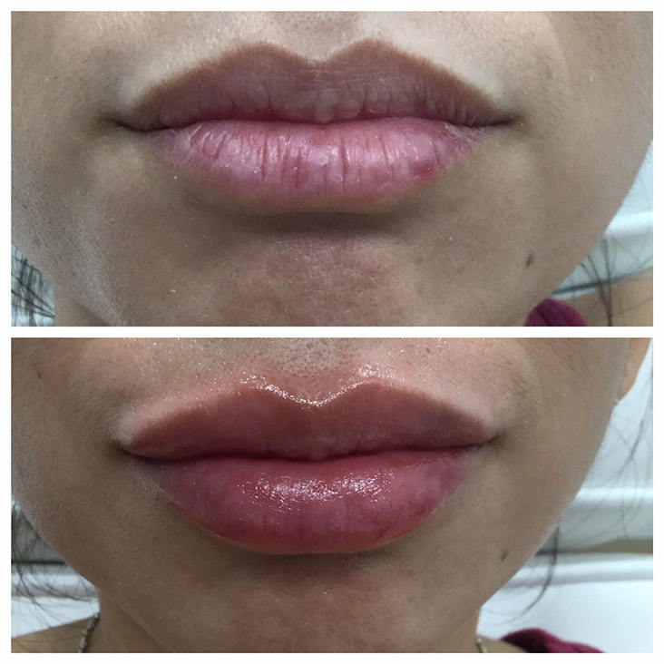 Female Patient 2.3ml Juvederm
