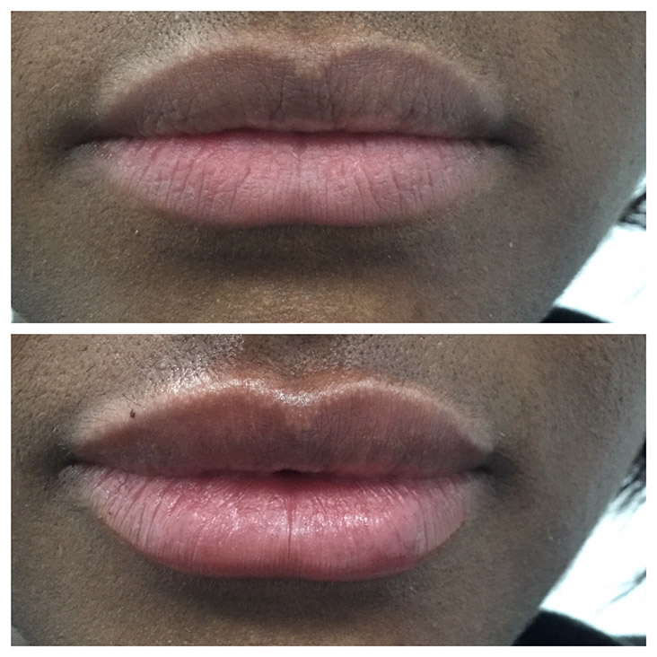 Female Patient 2.3ml Juvederm