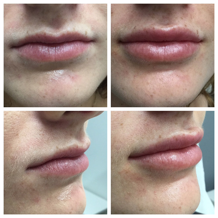 Female Patient 2.3ml Juvederm