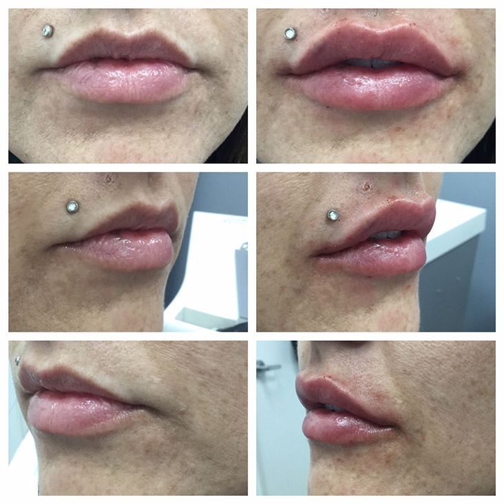 Female Patient 2.3ml Juvederm