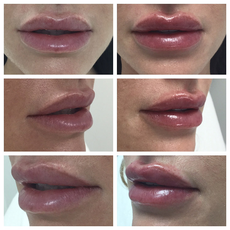 Female Patient 2.3ml Juvederm