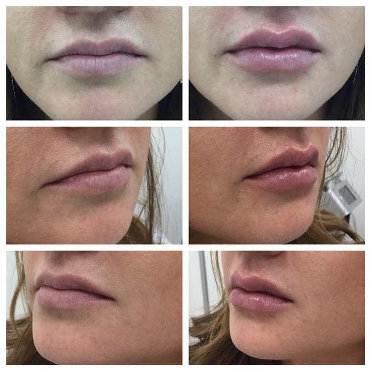 Female Patient 2.3ml Juvederm