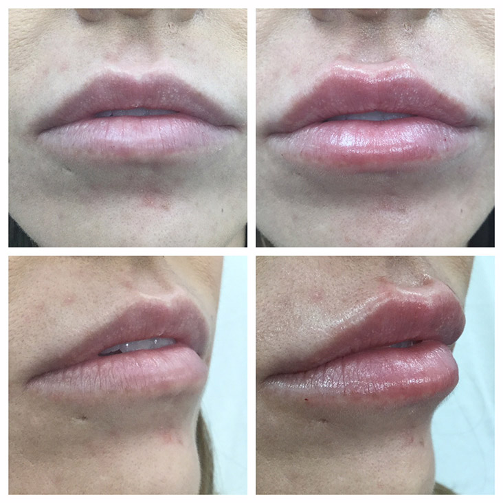 Female Patient 2.3ml Juvederm