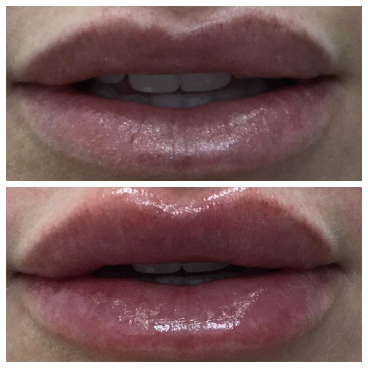 Female Patient 2.3ml Juvederm