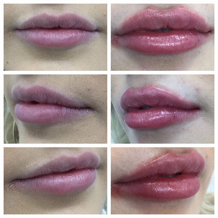 Female Patient 2.3ml Juvederm