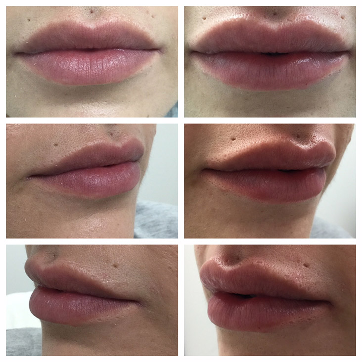 Female Patient 2.3ml Juvederm