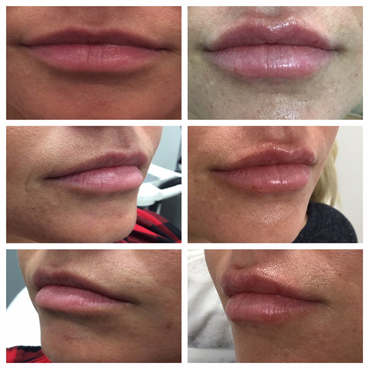 Female Patient 2.3ml Juvederm