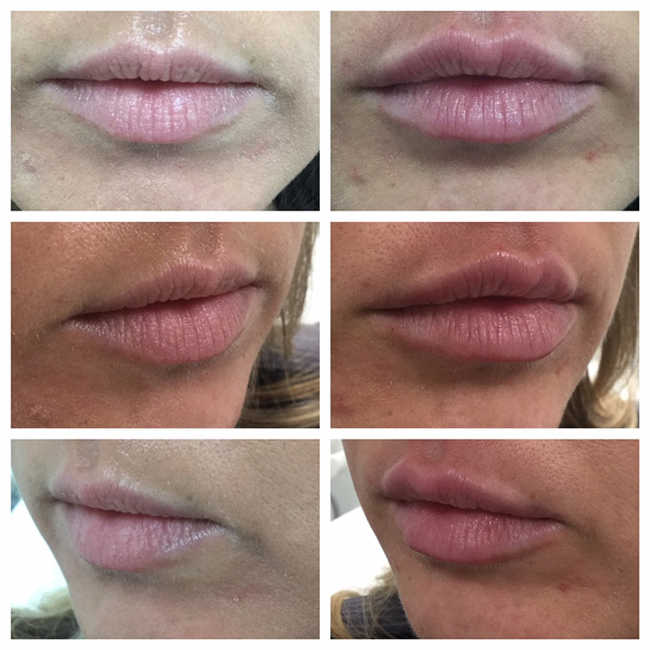 Female Patient 2.3ml Juvederm