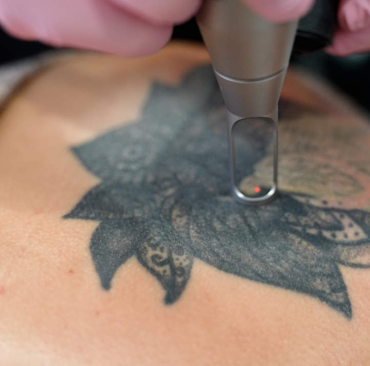 Laser Tattoo Removal  PiQo4 Treatment  Seattle Dermatology