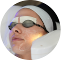 IPL Photofacial