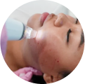Potenza RF Microneedling