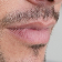 Lip Filler for Men treatment area