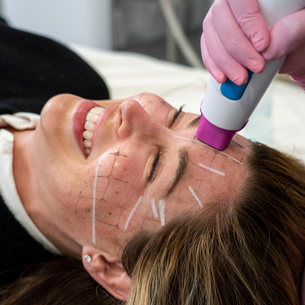 Sagging Face At 30 Rejuvenate With Thermage