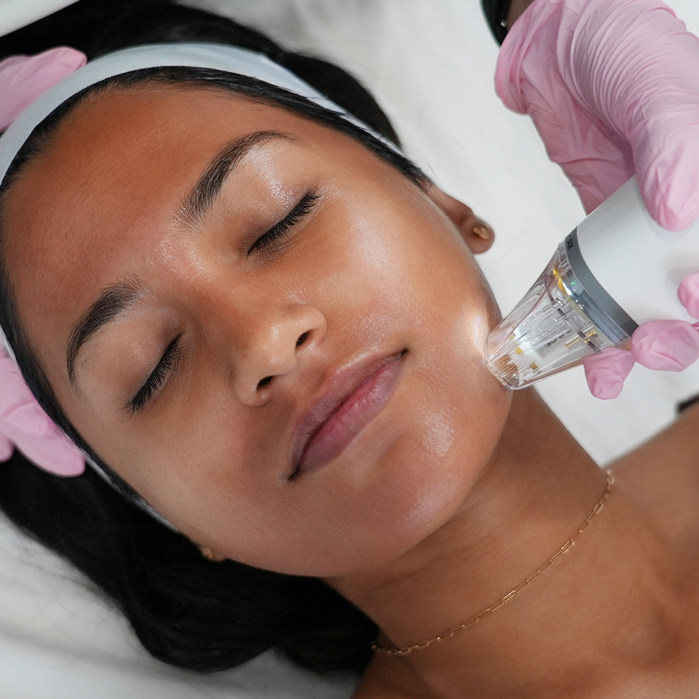 Microneedling Depth Chart: How Deep for Deep Acne Scars?