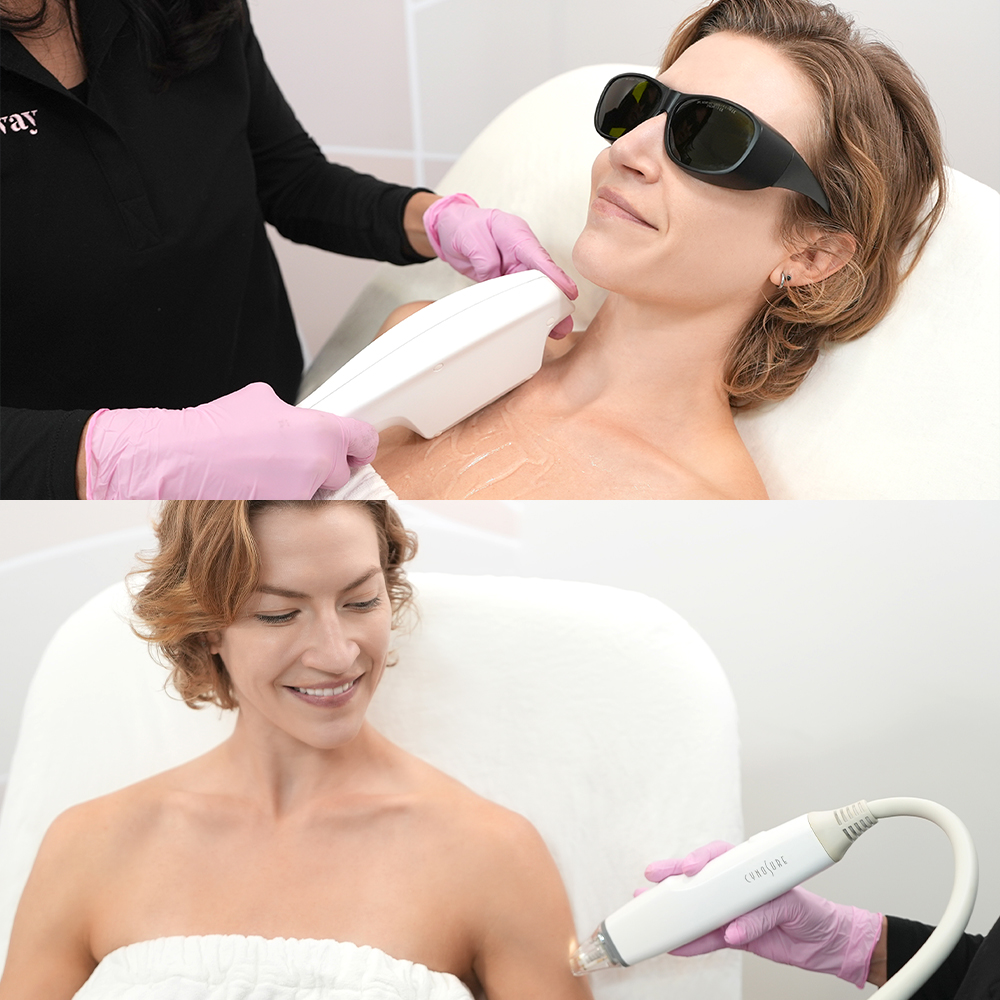 Ipl Vs Microneedling