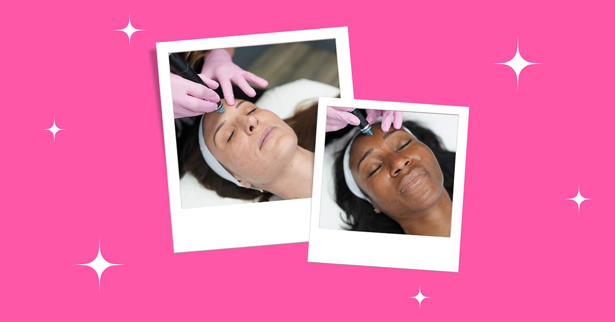 5 Reasons Why You Should Try Hydrafacials LaserAway