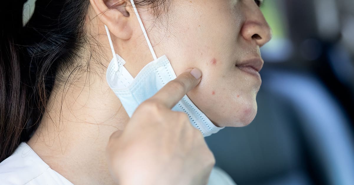 What’s “Maskne”? And How Can You Get Rid of It?