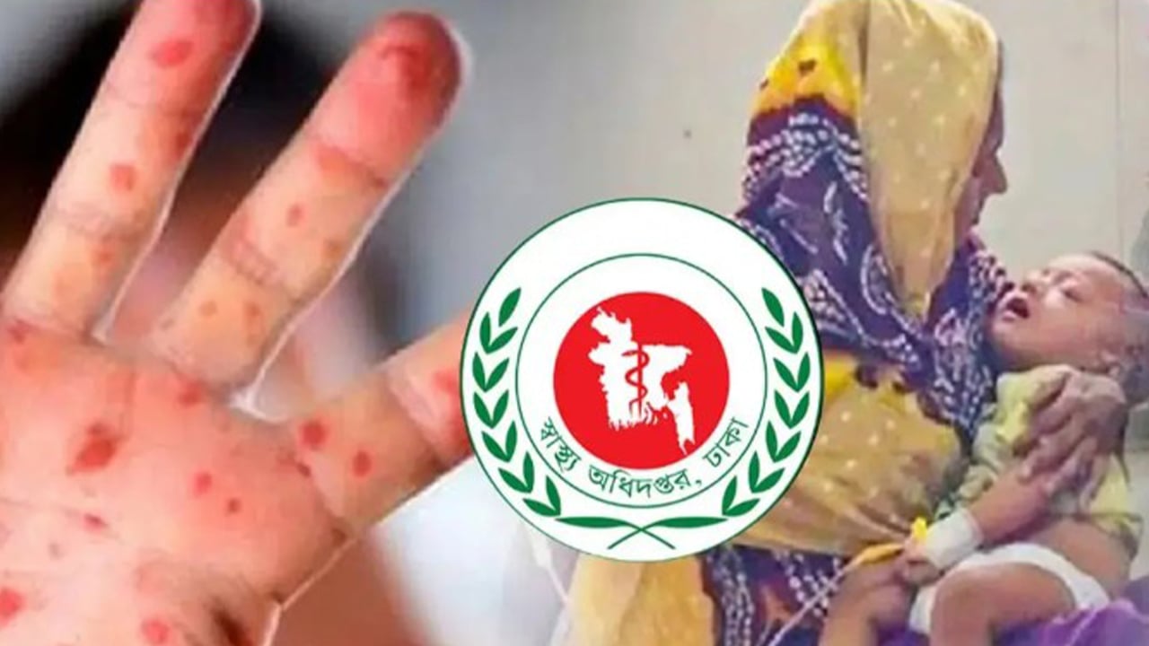 হাম ও উপসর্গে আরও ১১ জনের মৃত্যু ঘটেছে