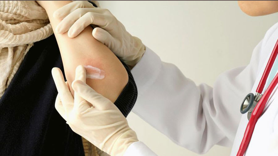 Eczema Complications