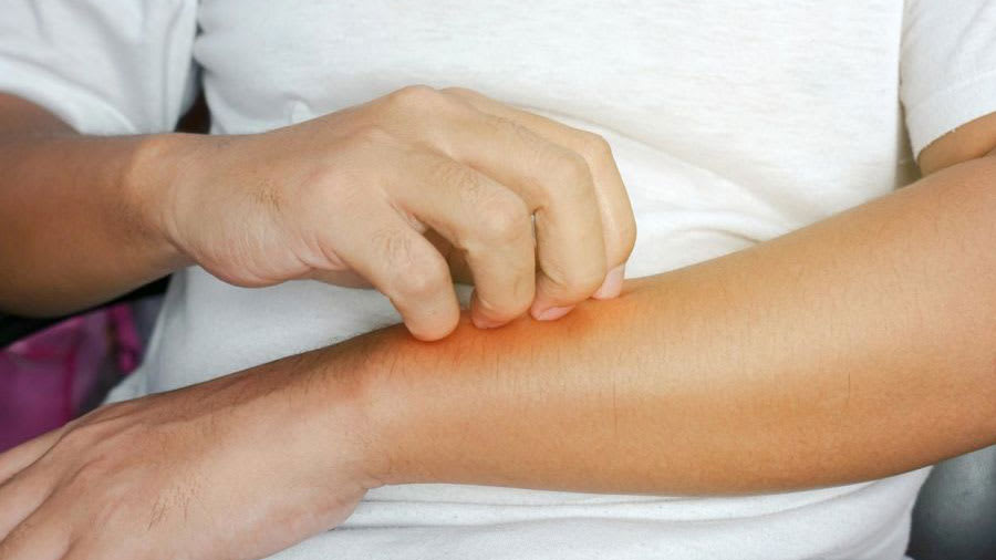 What Is Eczema?